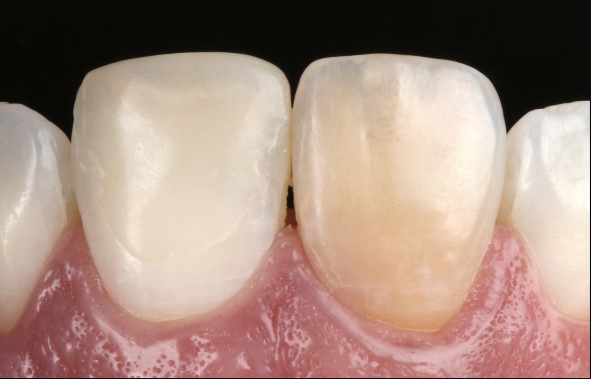 Dientes durante la estratificación con resina