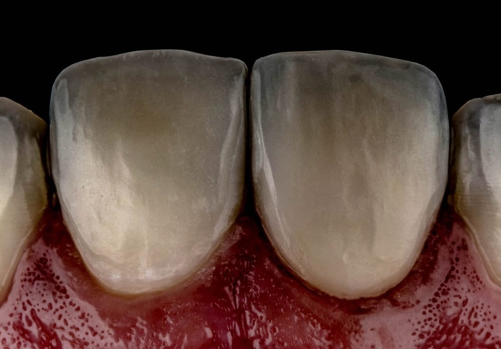 Dientes oscurecidos antes del tratamiento